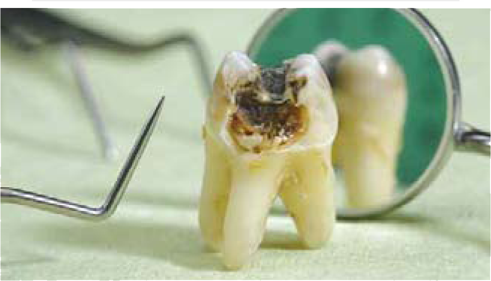 Gezogener Zahn